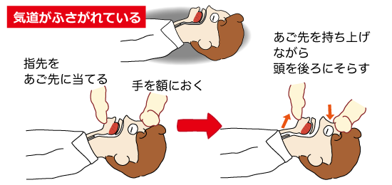 気道確保